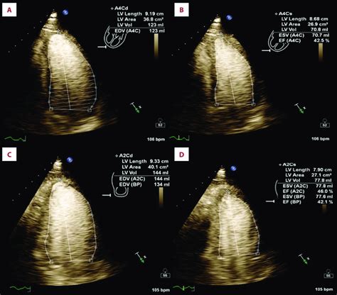 lvef tte transthoracic echo